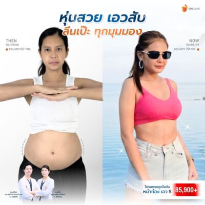 รีวิว Before & After เคสดูดไขมันรอบเอว ปีกข้าง 4
