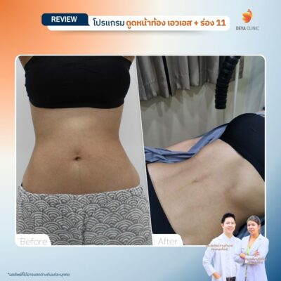 รีวิวดูดไขมันร่อง 11 02