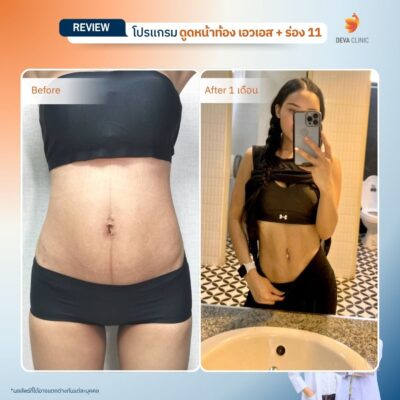 รีวิว ดูดไขมันร่อง 11 7