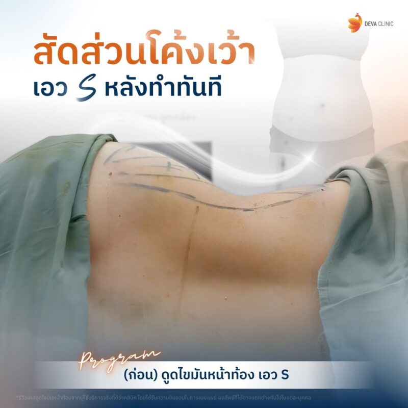 ดูดไขมันปีกข้างช่วยปั้นเอวคอด ลดไซส์กางเกงได้อย่างไร