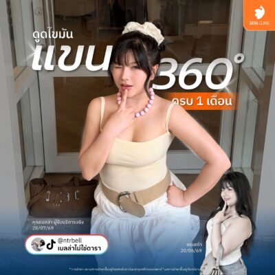 รีวิวความประทับใจจากคนไข้จริง หลังใช้โปรฯ ดูดไขมันเหมาจุด 6