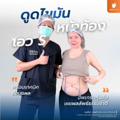 รีวิวก่อน-หลัง จากผู้ใช้บริการจริง ดูดไขมันพุง ราคา - 3