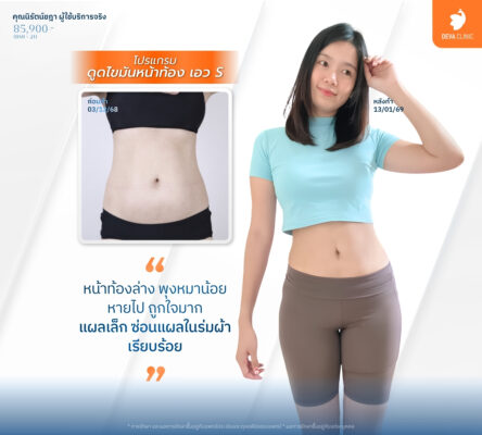 เทคนิคดูดไขมันแผลเล็ก - ดูดไขมันราคาเหมา ทั้งตัว 2