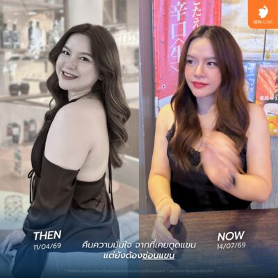 รีวิวความประทับใจจากคนไข้จริง หลังใช้โปรฯ ดูดไขมันเหมาจุด 5