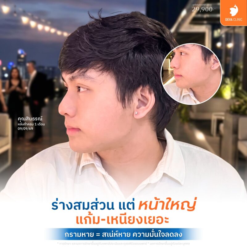 ปริมาณไขมันนิดเดียว แต่เปลี่ยนมิติหน้าได้มหาศาล - ดูดไขมันกรอบหน้า ราคา
