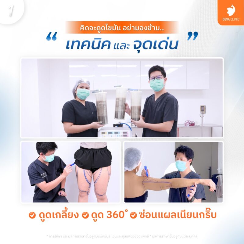เทคนิคเหลาเอวเอส ดูดไขมันปีกข้าง