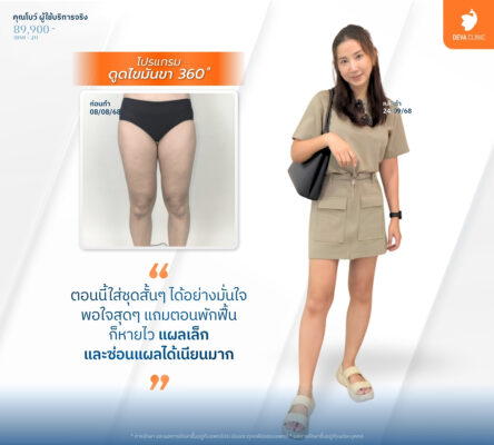 เทคนิคดูดไขมันแผลเล็ก - ดูดไขมันราคาเหมา ทั้งตัว 6