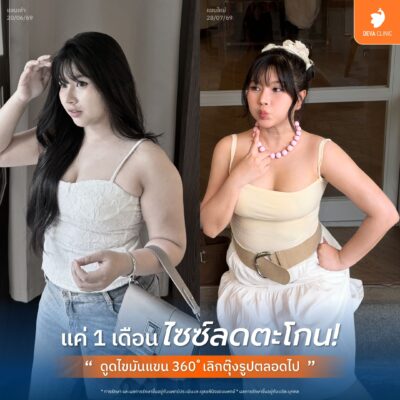 รีวิวความประทับใจจากคนไข้จริง หลังใช้โปรฯ ดูดไขมันเหมาจุด 1