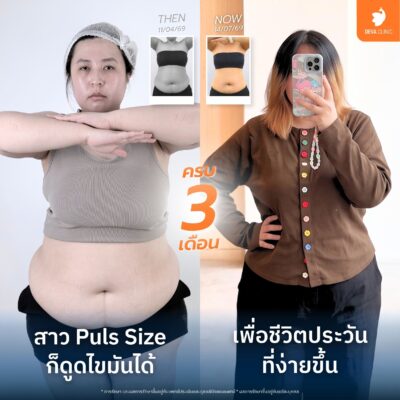 รีวิวดูดหน้าท้อง แพ็คเกจดูดไขมันทั้งตัว 1