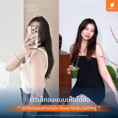 รีวิวความประทับใจจากคนไข้จริง หลังใช้โปรฯ ดูดไขมันเหมาจุด 3