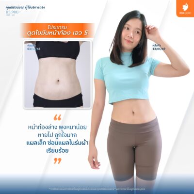 เทคนิคเฉพาะแผลเล็ก ซ่อนรอยตามแนวธรรมชาติ - ดูดไขมันผ่อนบัตรเครดิต 4