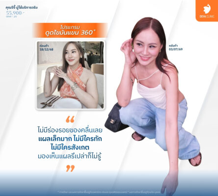 เทคนิคดูดไขมันแผลเล็ก - ดูดไขมันราคาเหมา ทั้งตัว 4