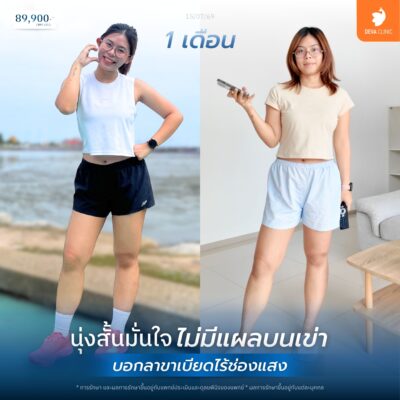 รีวิว เทคนิคซ่อนรอยแผลบริเวณรอยพับใต้ก้น 1