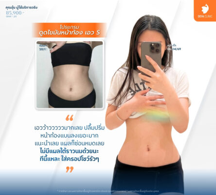 เทคนิคดูดไขมันแผลเล็ก - ดูดไขมันราคาเหมา ทั้งตัว 5