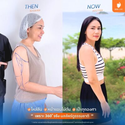 ดูดแขน 360 องศา จริงหรือเก็จ? เช็กลิสต์ 4 ข้อ ป้องกันการโดนหลอก 4