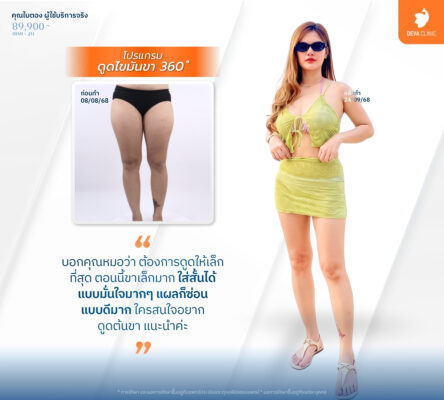 เทคนิคดูดไขมันแผลเล็ก - ดูดไขมันราคาเหมา ทั้งตัว 3