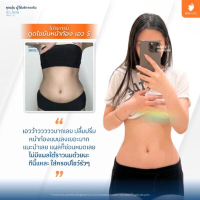 เทคนิคเฉพาะแผลเล็ก ซ่อนรอยตามแนวธรรมชาติ - ดูดไขมันผ่อนบัตรเครดิต 7