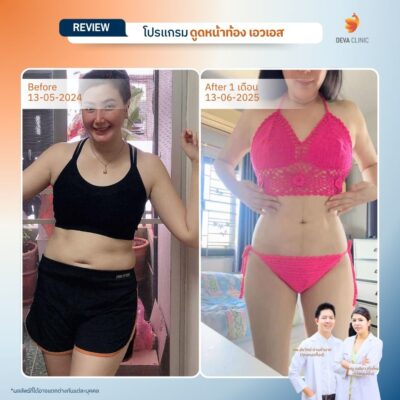รีวิวดูดไขมันปีกข้าง 2