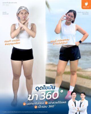 รีวิวดูดไขมันต้นขา แพ็คเกจดูดไขมันทั้งตัว 2