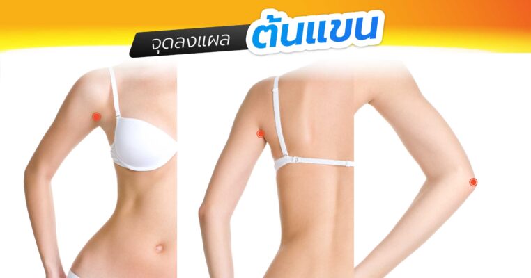จุดลงแผลต้นแขน