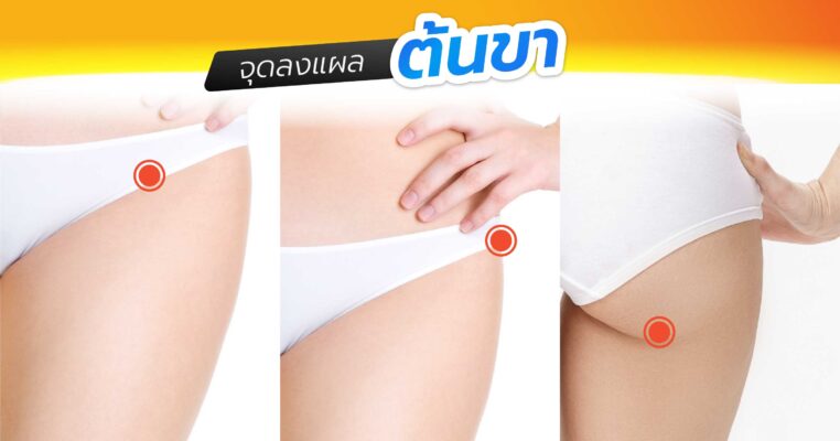 จุดลงแผลต้นขา