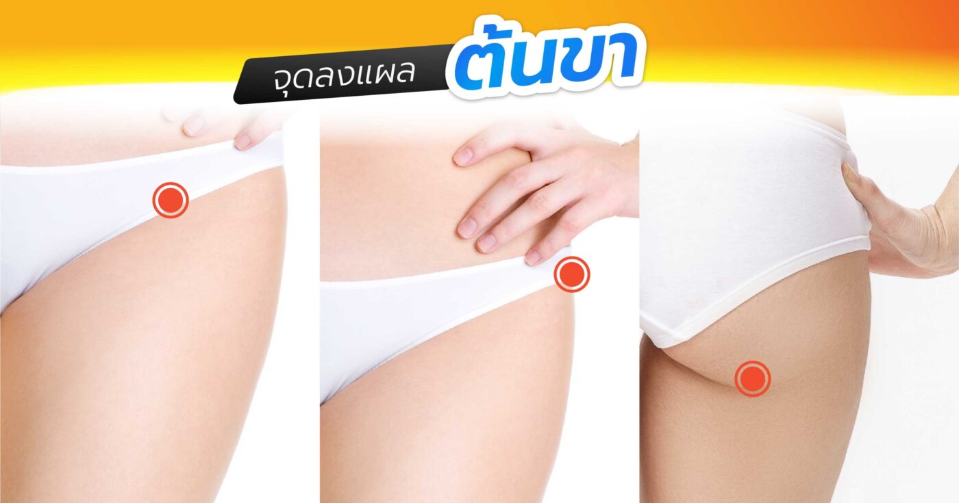ทคนิคซ่อนรอยแผลบริเวณรอยพับใต้ก้น (Gluteal Fold)