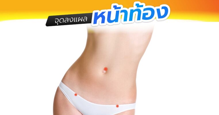 จุดลงแผลหน้าท้อง