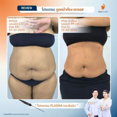 รีวิวผลลัพธ์หลังทำ ดูดไขมันกระชับผิว ราคา 20