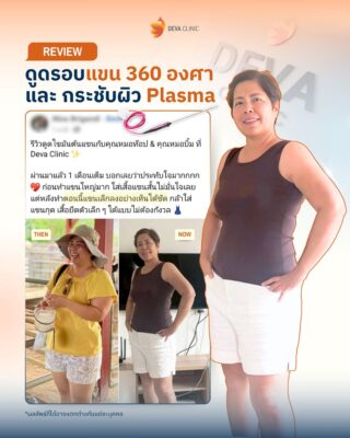รีวิวความประทับใจ ดูดไขมันกระชับผิว ราคา 3