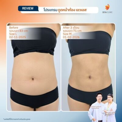 Before & After ดูดไขมันหน้าท้อง 14