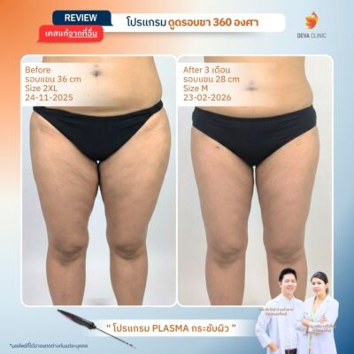 รีวิวผลลัพธ์หลังทำ ดูดไขมันกระชับผิว ราคา 19
