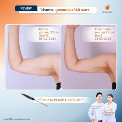 รีวิวผลลัพธ์หลังทำ ดูดไขมันกระชับผิว ราคา 2