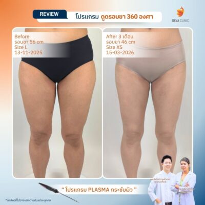 รีวิวผลลัพธ์หลังทำ ดูดไขมันกระชับผิว ราคา 18