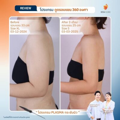 รีวิวผลลัพธ์หลังทำ ดูดไขมันกระชับผิว ราคา 3