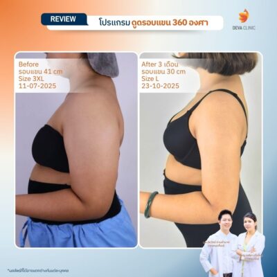 Before & After ดูดไขมันต้นแขน 17
