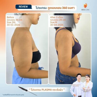 รีวิวผลลัพธ์หลังทำ ดูดไขมันกระชับผิว ราคา 17