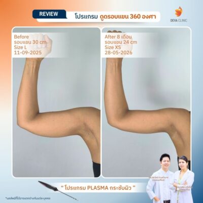 รีวิวผลลัพธ์หลังทำ ดูดไขมันกระชับผิว ราคา 16