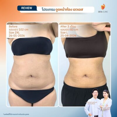 Before & After ดูดไขมันหน้าท้อง 10