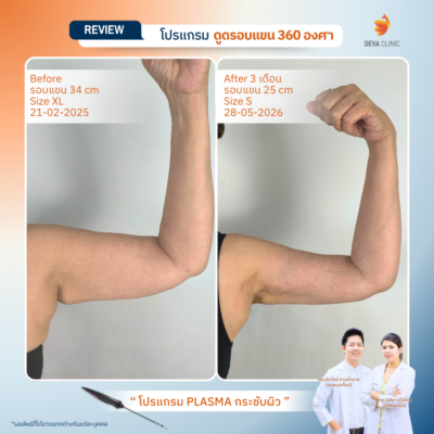 รีวิวผลลัพธ์หลังทำ ดูดไขมันกระชับผิว ราคา 15