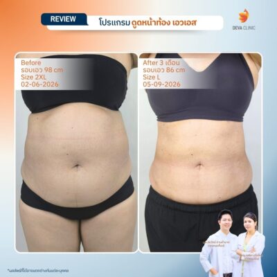 Before & After ดูดไขมันหน้าท้อง 7