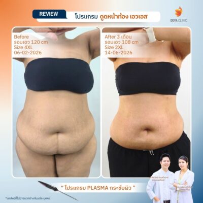 Before & After ดูดไขมันหน้าท้อง 5