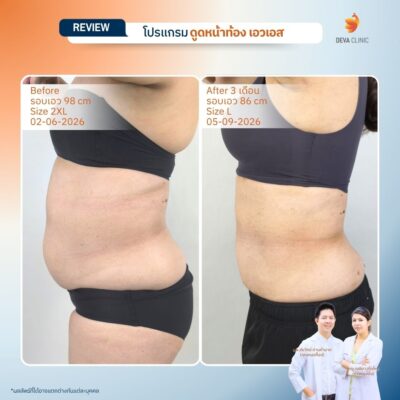 Before & After ดูดไขมันหน้าท้อง 6
