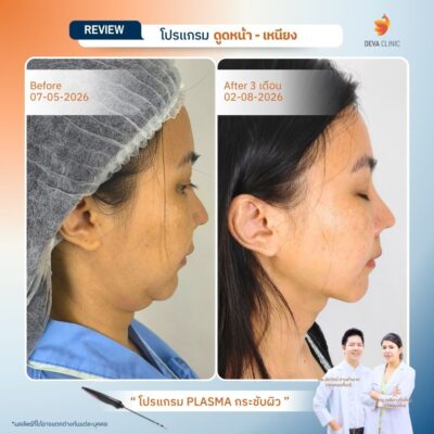 Before & After ดูดไขมันหน้า เหนียง 9