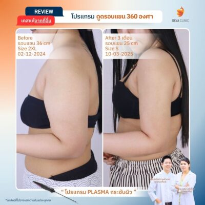 รีวิวผลลัพธ์หลังทำ ดูดไขมันกระชับผิว ราคา 5