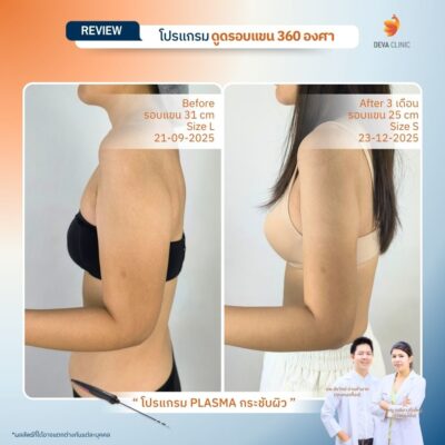 รีวิวผลลัพธ์หลังทำ ดูดไขมันกระชับผิว ราคา 11