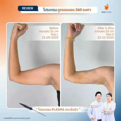 รีวิวผลลัพธ์หลังทำ ดูดไขมันกระชับผิว ราคา 12
