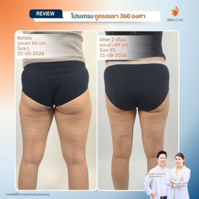 Before & After ดูดไขมันต้นขา 18