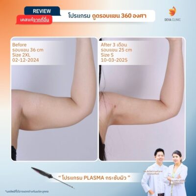 รีวิวผลลัพธ์หลังทำ ดูดไขมันกระชับผิว ราคา 1