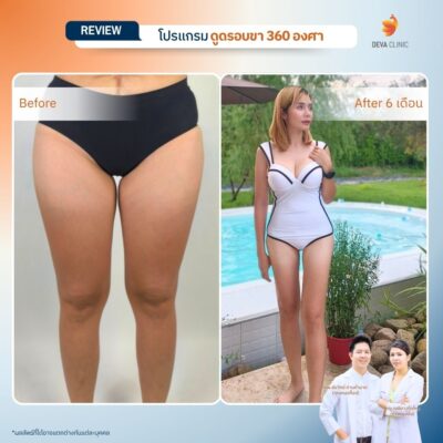Before & After ดูดไขมันต้นขา 1