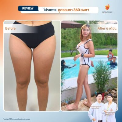 Before & After ดูดไขมันต้นขา 10